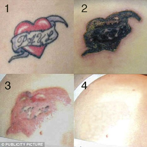 Tattoo removal is neither simple nor pain free.