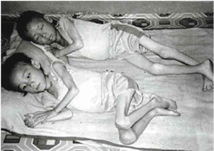 North Korean children suffering from malnutrition