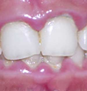 Inflamed Gums