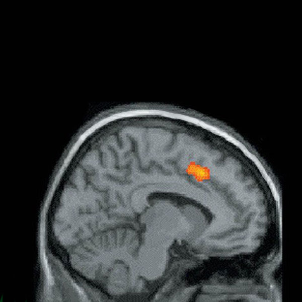 Enlarged Anterior Cingulate