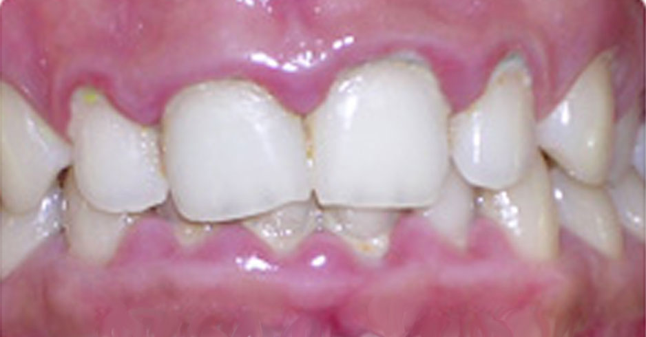 Inflamed Gums